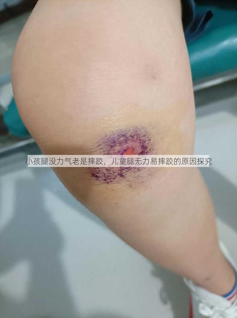 小孩腿没力气老是摔跤